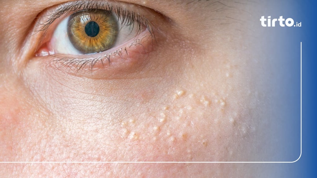 Milia Di Mata Penyebab Jenis Dan Cara Mengatasinya