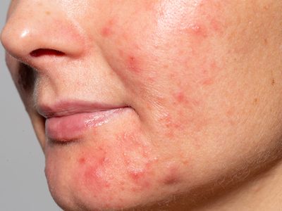 Cystic Acne Masalah Kecantikan Anak Muda