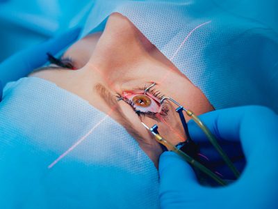 Tindakan Operasi Mata Untuk Menghilangkan Kotoran Minus