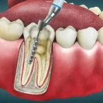 Perawatan Intensif Gigi Dalam Pada Akar Maupun Saraf