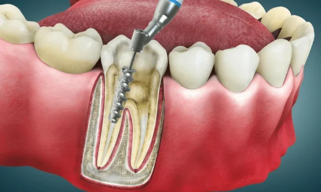 Perawatan Intensif Gigi Dalam Pada Akar Maupun Saraf
