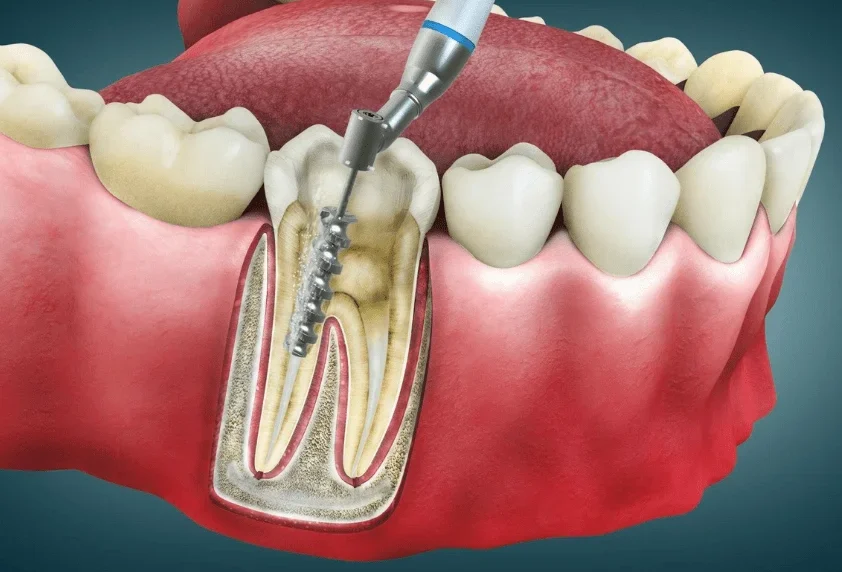 Perawatan Intensif Gigi Dalam Pada Akar Maupun Saraf