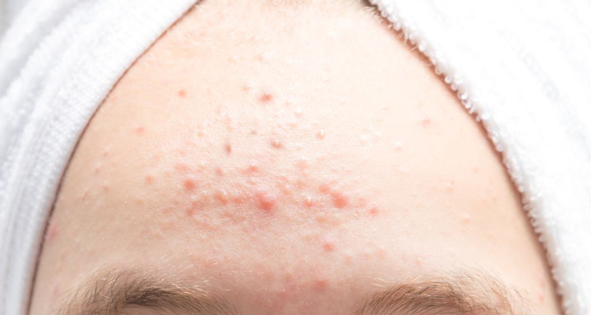 Jerawat Dahi Membandel? Ini Biang Kerok Dan Solusinya