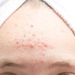 Jerawat Dahi Membandel? Ini Biang Kerok Dan Solusinya