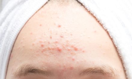 Jerawat Dahi Membandel? Ini Biang Kerok Dan Solusinya