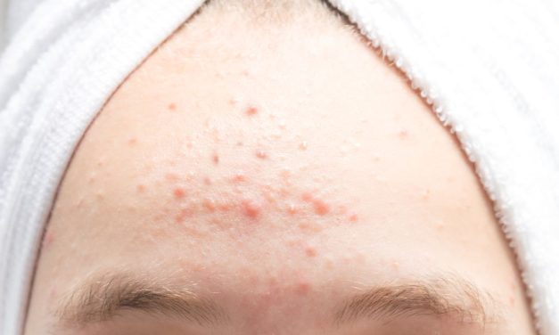 Jerawat Dahi Membandel? Ini Biang Kerok Dan Solusinya